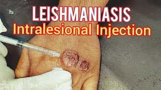 Leishmaniasis Treatment [upl. by Arymat953]