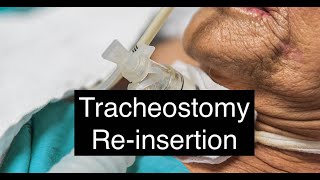 Tracheostomy Reinsertion [upl. by Hizar]