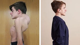 John Sarconas Testimonial  Overcoming Severe Scoliosis and Kyphosis [upl. by Erihppas978]