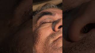 Extraction of senile periorbital comedones dr Bhutada Skin India [upl. by Charbonnier]