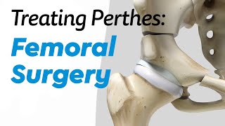 Femoral Surgery for Treating Perthes Disease in Children [upl. by Siramaj292]