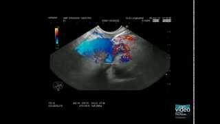 Advanced EUS imaging CEEUS lowMI high MI including 3D techniques in pancreatic imaging [upl. by Abate559]