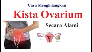 Cara Menghilangkan kista ovarium secara alami [upl. by Tacklind14]