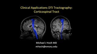 MRI Diffusion Tensor Imaging DTI interpretation  locating the corticospinal tract CST [upl. by Garretson]