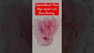 Vaginal Normal Flora Gram staining of High Vaginal Swab HV Epithelial Cells and Bacteria [upl. by Akanke]