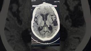 A Glimpse Inside CT Scan of a 97YearOld Brain 🧠 medical ctscan radiology neurology medicine [upl. by Eronel776]