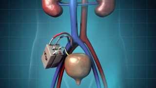 The Kidney Project at UCSF [upl. by Kamerman190]