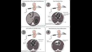 Basic fetal Echocardiography in Obstetric Practice [upl. by Bilek]