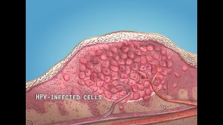 What are warts HPV  3D animation [upl. by Nniuqal]