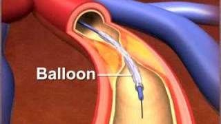 Percutaneous coronary Intervention stenting [upl. by Selec]