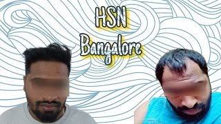 Hair Transplant result review by our patient hairtransformation  HSN Contact no  9035554728 [upl. by Lindberg842]