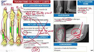 Fracturas Rádio y Cúbito  Ortopedia y Traumatología Clases Qx Medic  09 [upl. by Shirk689]