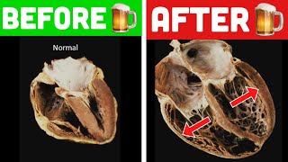 ALCOHOLIC CARDIOMYOPATHY  Doctor Explains [upl. by Akihdar202]