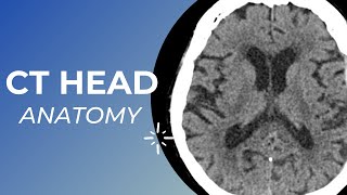 CT head anatomy for Medical students  residents and clinicians [upl. by Tihor]