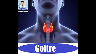 Goitre Thyroid Gland DiseasesCase Presentation  Medical Case Study Case Discussion Case Report [upl. by Haseefan]