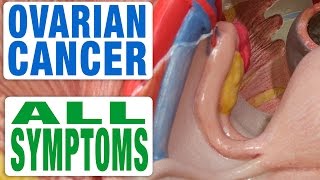 Ovarian Cancer  All Symptoms [upl. by Bohun]