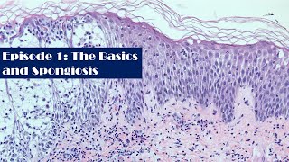 Episode1 A Survey of Dermatopathology The Basics and Spongiosis [upl. by Leva]