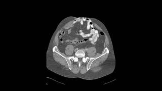 Péritonite  1 Diagnostic positif [upl. by Josefina]