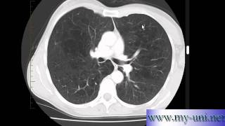 Emphysema on CT scan of Chest [upl. by Arratoon362]