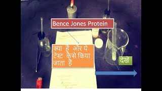 Bence Jones Proteinuria [upl. by Paloma823]