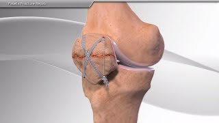 Patella Fracture Repair [upl. by Aiouqahs]