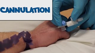 How to Perform Cannulation  OSCE Guide old version  UKMLA  CPSA [upl. by Nostaw843]