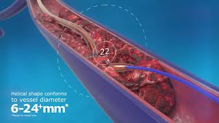 ClotHunter™ paired with ZelanteDVT™ Thrombectomy Catheter Enhancement [upl. by Grefe]