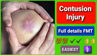 contusionBruise injury Typesmedicolegal importance [upl. by Asiela]