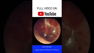 Bullous Myringitis Otoscopy [upl. by Neale964]