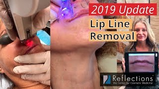 Lip Line Removal Options Fillers PDO Threads Lasers Nanofat PRP amp Microneedling [upl. by Zuckerman]