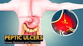 Peptic Ulcers Causes Signs and Symptoms Diagnosis and Treatment [upl. by Sussi]