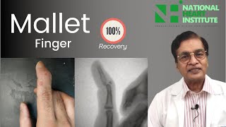 Mallet Finger Treatment In Hindi Dr Karoon Agrawal [upl. by Domel720]