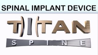 Titan Spine Trinsic Medical Animation [upl. by Yerroc]