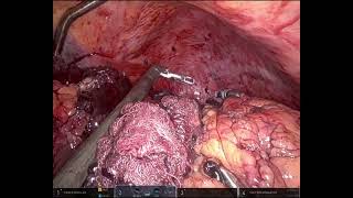 ACS robo splenectomy [upl. by Rebel564]