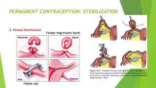 FAMILY PLANNING Birth control methods [upl. by Uot608]