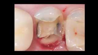 Indirect Posterior Resin Composite Restorations [upl. by Sidoma]