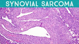 Synovial Sarcoma explained in 5 minutes Soft Tissue Pathology Basics [upl. by Ailatan]