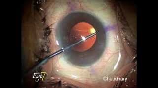 Toric IOL rotation after 15 days with Alcon Acrysof toric lens at Eye7 Delhi India [upl. by Horick981]