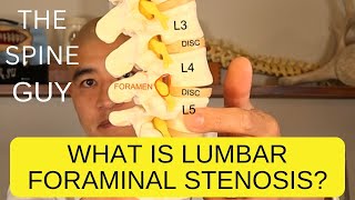 What is Lumbar Foraminal Stenosis [upl. by Assirual]