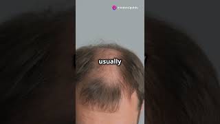 Understanding Alopecia  Causes amp Mechanism  biology science knowledge shorts shortsvideo [upl. by Ylicis]