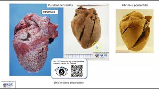 Heart Purulent pericarditis Gross pathology [upl. by Goodspeed]