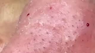 🤯 pimples poping from nose Nose full of blackheads removal blackheads and whiteheads removal [upl. by Kirad]