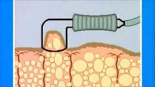 WEYERGANS TV SPM Treatment [upl. by Louisette358]