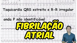 Eletrocardiograma  análise  Fibrilação atrial [upl. by Tyra]