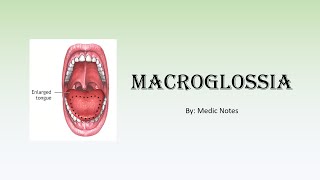 Macroglossia  causes pathophysiology BeckwithWiedemann syndrome hypothyroidism lymphangioma [upl. by Nealah]