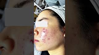 Mesotherapy giảm đỏ  giảm viêm skincare bacsidalieu lamdep mesotherapy peelda trimun shorts [upl. by Isnam4]