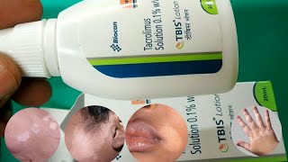 Tbis Lotion  Tacrolimus Solution 01 Lotion  Tbis Lotion use side effect benefit सफेद दाग के लिए [upl. by Jehiel]