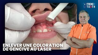 Comment enlever coloration de Gencive au Laser   Frank Pourrat [upl. by Depoliti296]