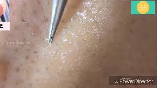 Plucking out pimples Satisfying video [upl. by Vashti941]