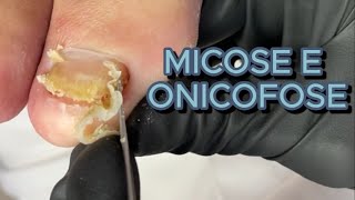 OLHA O RESULTADO DESSA REMOÇÃO DE ONICOFOSE COM PEELING satisfying viral [upl. by Noevart]